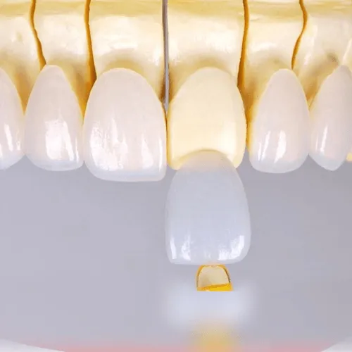 dv-dan-su-veneer